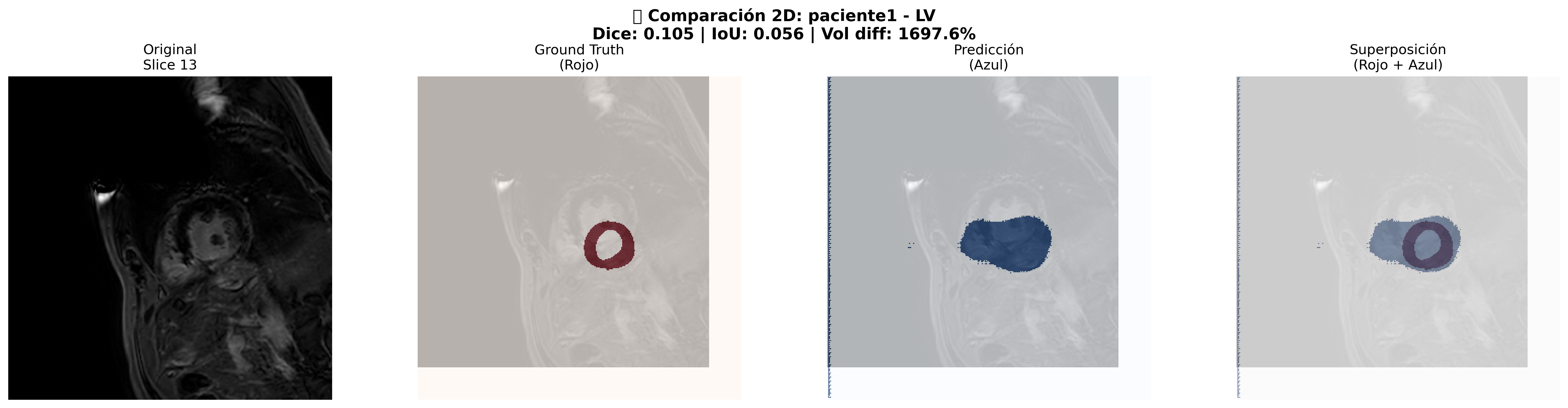 Comparación 2D Detallada - Paciente 1 LV