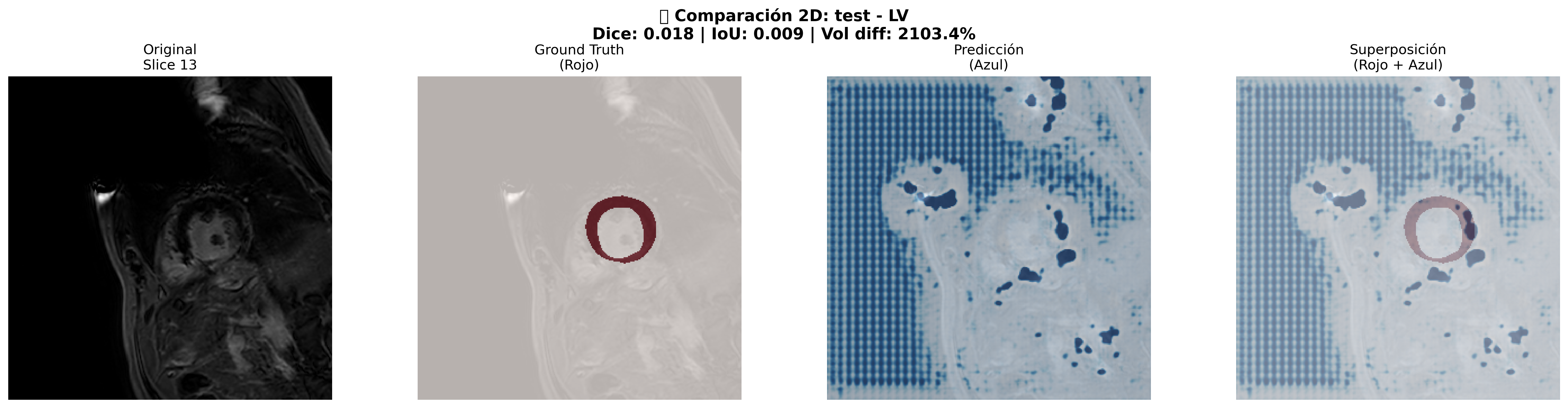 Comparación 2D Detallada - Paciente Test LV